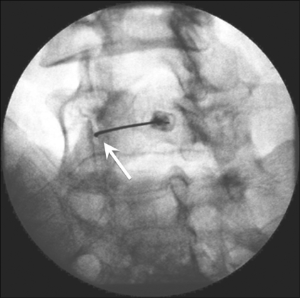Oblique fluoroscopy during a lumbar L4-L5 facet joint injection: the needle is in intra-articular position, arrow on its tip.
