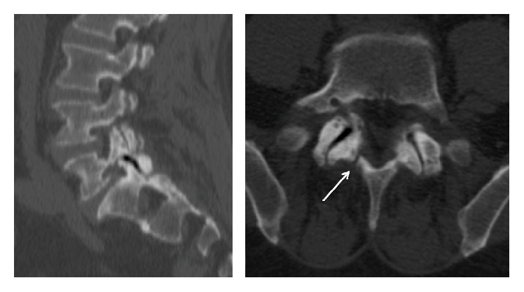 Sagittal and axial lumbar CT scan: severe facet joint osteoarthritis with a vacuum sign, the arrow marking an associated L5 pars interarticularis lysis.