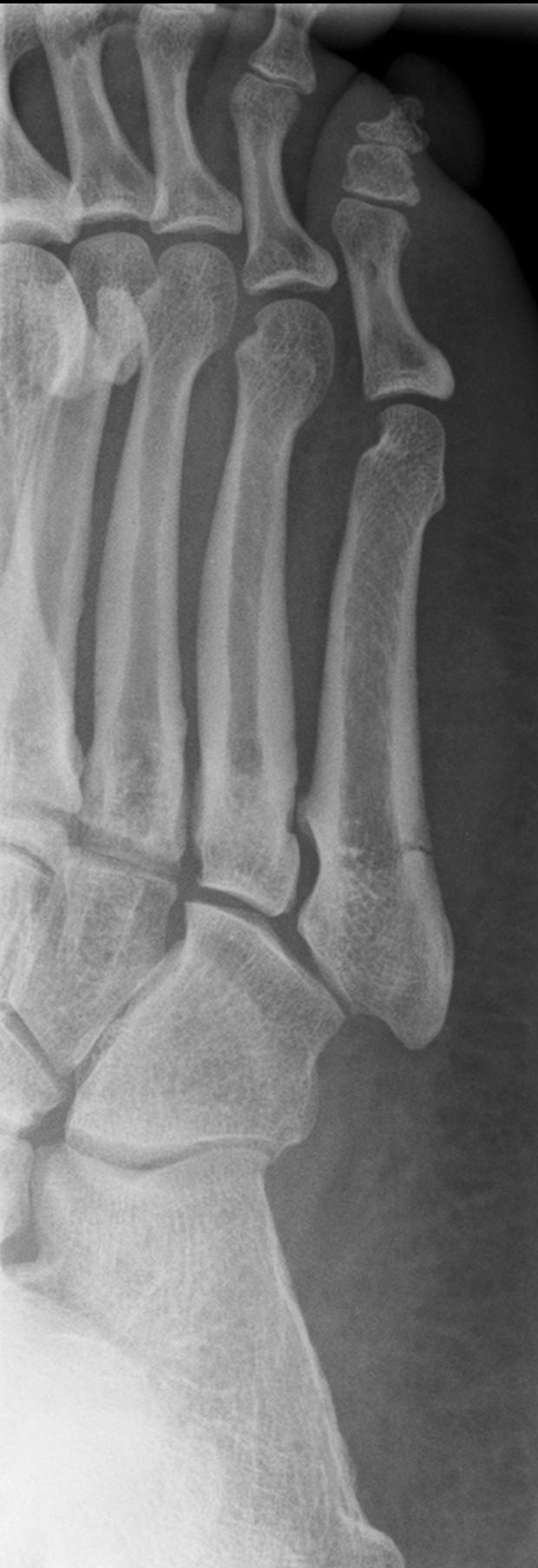 Frontal foot X-ray: transverse fracture line visible at the base of the 5th metatarsal (Jones fracture), without displacement.
