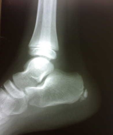 Radiographie du pied de profil chez un enfant : fragmentation et sclérose de l'apophyse calcanéenne, signes caractéristiques de la maladie de Sever.