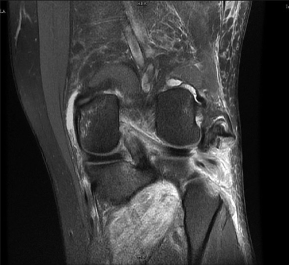 Coronal knee MRI: high signal intensity within the anterior cruciate ligament with fibre disruption, suggestive of a left anterior cruciate ligament tear.