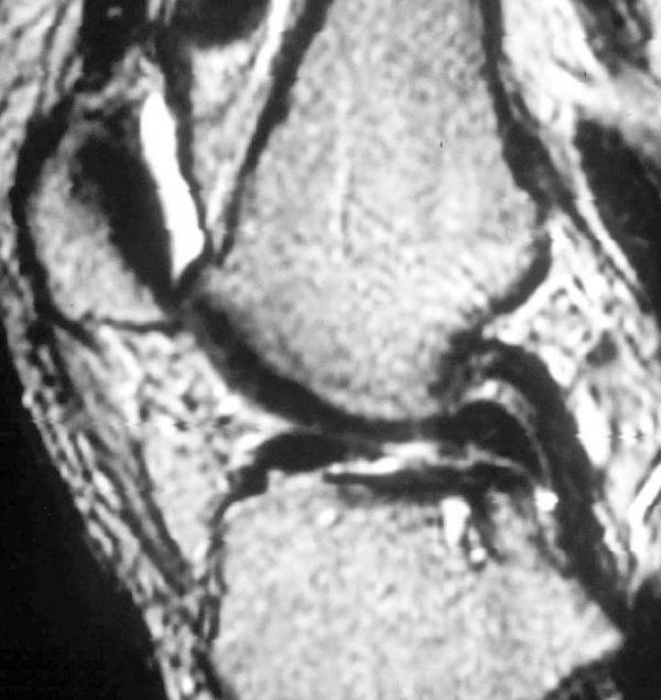 Sagittal knee MRI: poor visualisation of the anterior cruciate ligament substance, a sign suggestive of rupture in a patient presenting with internal derangement of the knee.