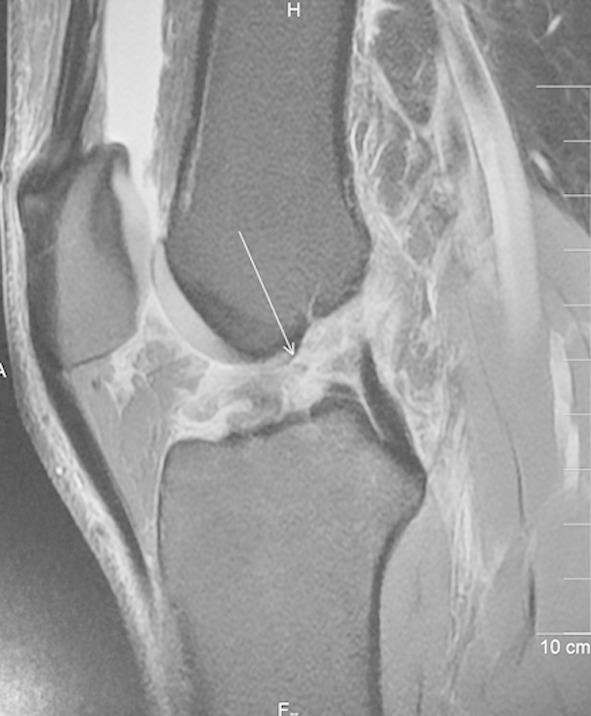 Sagittal knee MRI, arrow on the anterior cruciate ligament: partial rupture involving approximately 75 percent of the ligamentous body, confirmed at arthroscopy.
