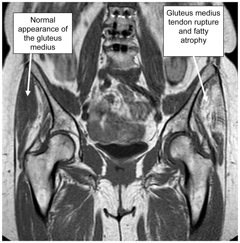 Coronal pelvic MRI comparing a normal gluteus medius and a gluteus medius tendon tear with fatty atrophy on the affected side.