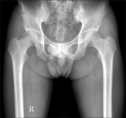 Frontal pelvic X-ray: positive crossover sign at both hips, suggestive of pincer-type femoroacetabular impingement, in a 25-year-old man with left hip pain.
