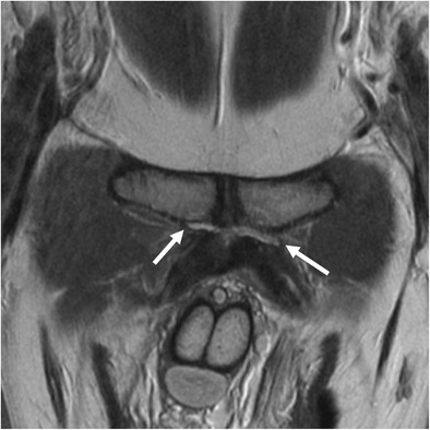 Coronal pelvic MRI, PD weighting: bilateral hyperintense clefts at the origin of the adductor tendons on the pubic symphysis, more marked on the left, indicating adductor tendinopathy (arrows).