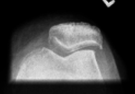 Radiographie du genou en incidence fémoro-patellaire (vue axiale de rotule) montrant une subluxation latérale de la rotule dans la trochlée.