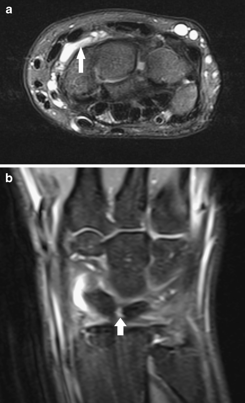 Axial and coronal wrist MRI, fat-saturated T2-weighted sequences: small dorsal ganglion cyst with high signal intensity, arrow on an associated tear of the scapholunate ligament.