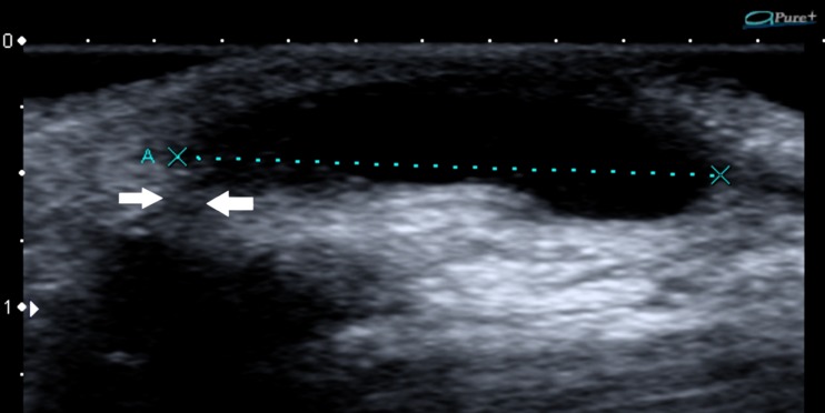 Longitudinal wrist ultrasound: well-defined anechoic structure on the palmar aspect of the carpus, arrows on the stalk connecting the cyst to the radiocarpal joint.