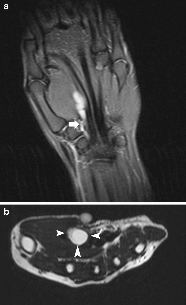Coronal and axial wrist MRI, fat-saturated T2-weighted sequences: polylobulated volar ganglion cyst with high signal intensity, arrows on the stalk connecting the cyst to the scaphotrapezial joint.