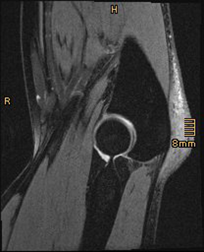 Sagittal elbow MRI, T2 sequence: olecranon bursitis, thickened bursa with heterogeneous signal behind the olecranon.