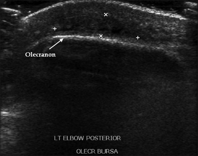 Longitudinal ultrasound of the posterior aspect of the elbow: effusion and echogenic debris within the olecranon bursa, arrow on the olecranon.