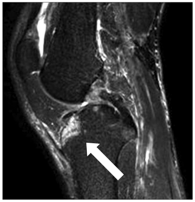 IRM du genou en coupe sagittale : contusion osseuse (œdème médullaire) du plateau tibial latéral après une lésion du ligament croisé postérieur, flèche sur la zone atteinte.