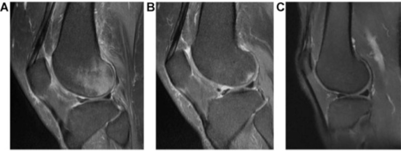 IRM du genou en coupes sagittales successives : contusion osseuse de type I, hypersignal médullaire visible sur les trois clichés après traumatisme.