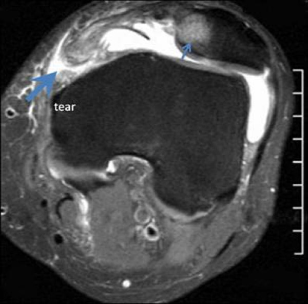 IRM du genou en coupe axiale : contusion osseuse de la facette patellaire médiale (petite flèche) et déchirure du ligament fémoro-patellaire médial (grande flèche) après luxation de rotule.