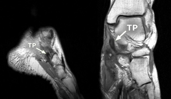 IRM du pied en coupes frontale et sagittale : rupture du tendon du muscle tibial postérieur (flèches), cause fréquente de pied plat acquis de l'adulte.