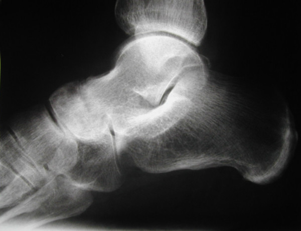 Radiographie de profil du pied : destruction et pincement de l'articulation talo-naviculaire, avec affaissement de la voûte plantaire, aspect radiologique du pied plat évolué.