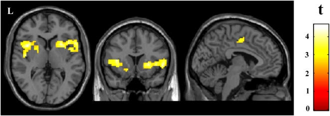 IRM fonctionnelle cérébrale, coupes axiale, coronale et sagittale : zones jaunes d'activation accrue à la douleur chez les patients fibromyalgiques par rapport aux sujets sains, reflétant une sensibilisation centrale.