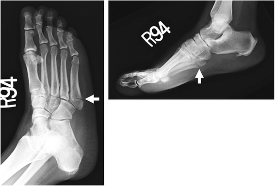 Anteroposterior and lateral X-rays of the foot: transverse Jones fracture, about 2 cm distal to the base of the fifth metatarsal, arrows on the fracture line.