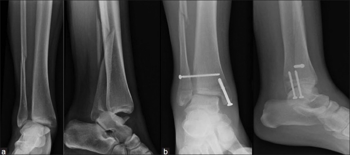 Radiographies de cheville : fracture bimalléolaire déplacée (a), puis fixation de la syndesmose seule par vis, sans ostéosynthèse du péroné ; à 7 semaines, syndesmose imparfaitement réduite et fracture fibulaire non consolidée (b).