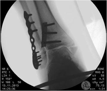 Radiographie de cheville en vue mortaise après ostéosynthèse : plaque anti-glissement sur la malléole postérieure et plaque vissée sur la malléole latérale.