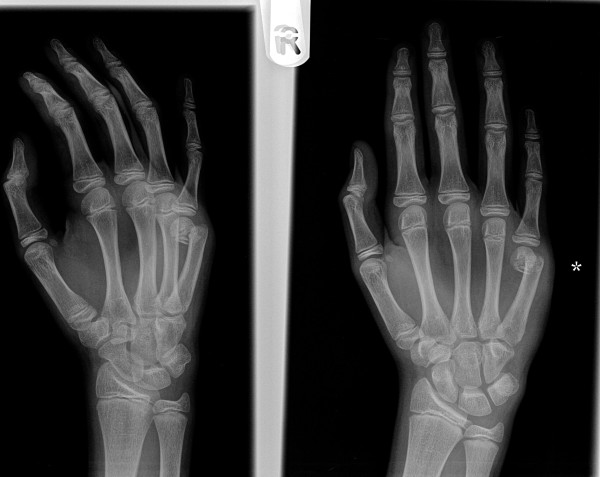 Oblique and anteroposterior X-rays of the hand: displaced fracture of the fifth metacarpal neck, angulation visible at the fracture site.