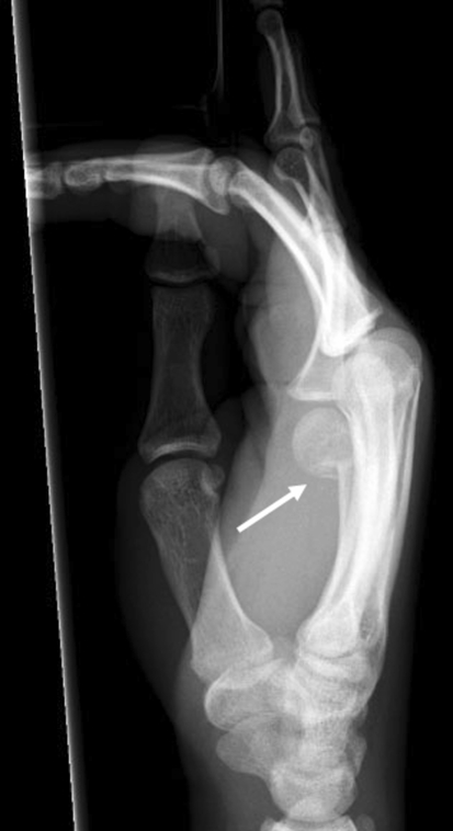 Lateral X-ray of the hand: fracture of the fifth metacarpal neck, known as a boxer's fracture, with volar angulation, arrow on the fracture site.