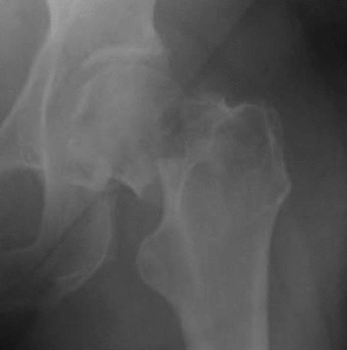 Radiographie de hanche en gros plan chez une femme de 75 ans : fracture déplacée du col fémoral, tête et col désaxés par rapport à la diaphyse.