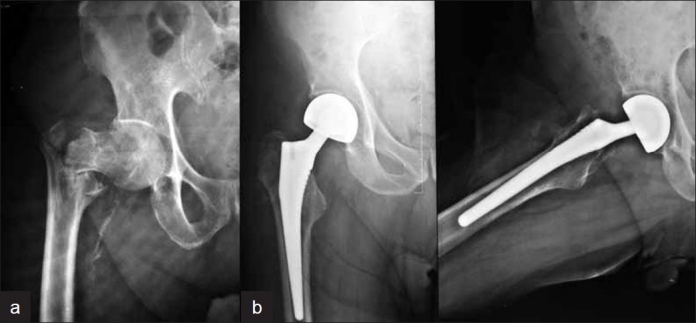 Radiographies de hanche chez une patiente âgée de 73 ans : fracture intertrochantérienne instable avant opération, puis hémiarthroplastie sans ciment après consolidation.