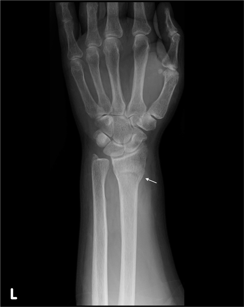Radiographie de poignet de face : fracture du radius distal, flèche sur le trait de fracture métaphysaire.