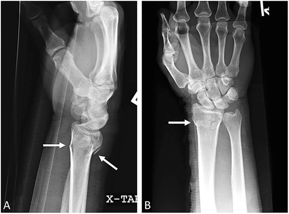 Radiographies de poignet de profil et de face : fracture de Colles, flèches sur le trait métaphysaire du radius distal avec bascule dorsale du fragment.