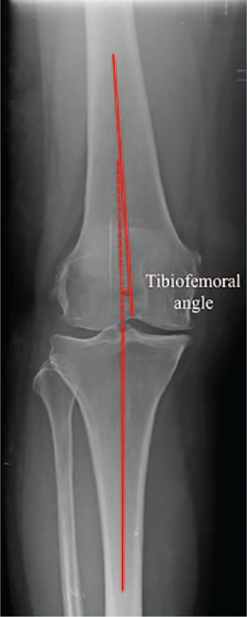 Radiographie de genou de face avec tracé de l'angle fémoro-tibial : cette mesure de l'axe du membre quantifie la déviation en varus ou en valgus qui accompagne la gonarthrose.