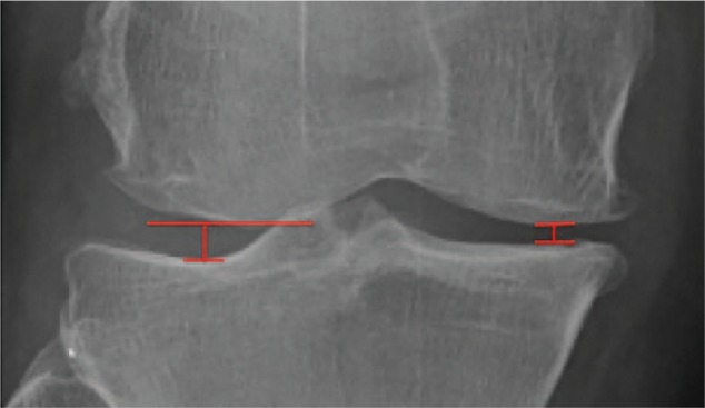 Radiographie de genou en gros plan : mesure de la largeur de l'interligne articulaire médial et latéral, technique utilisée pour évaluer le pincement lié à la gonarthrose.