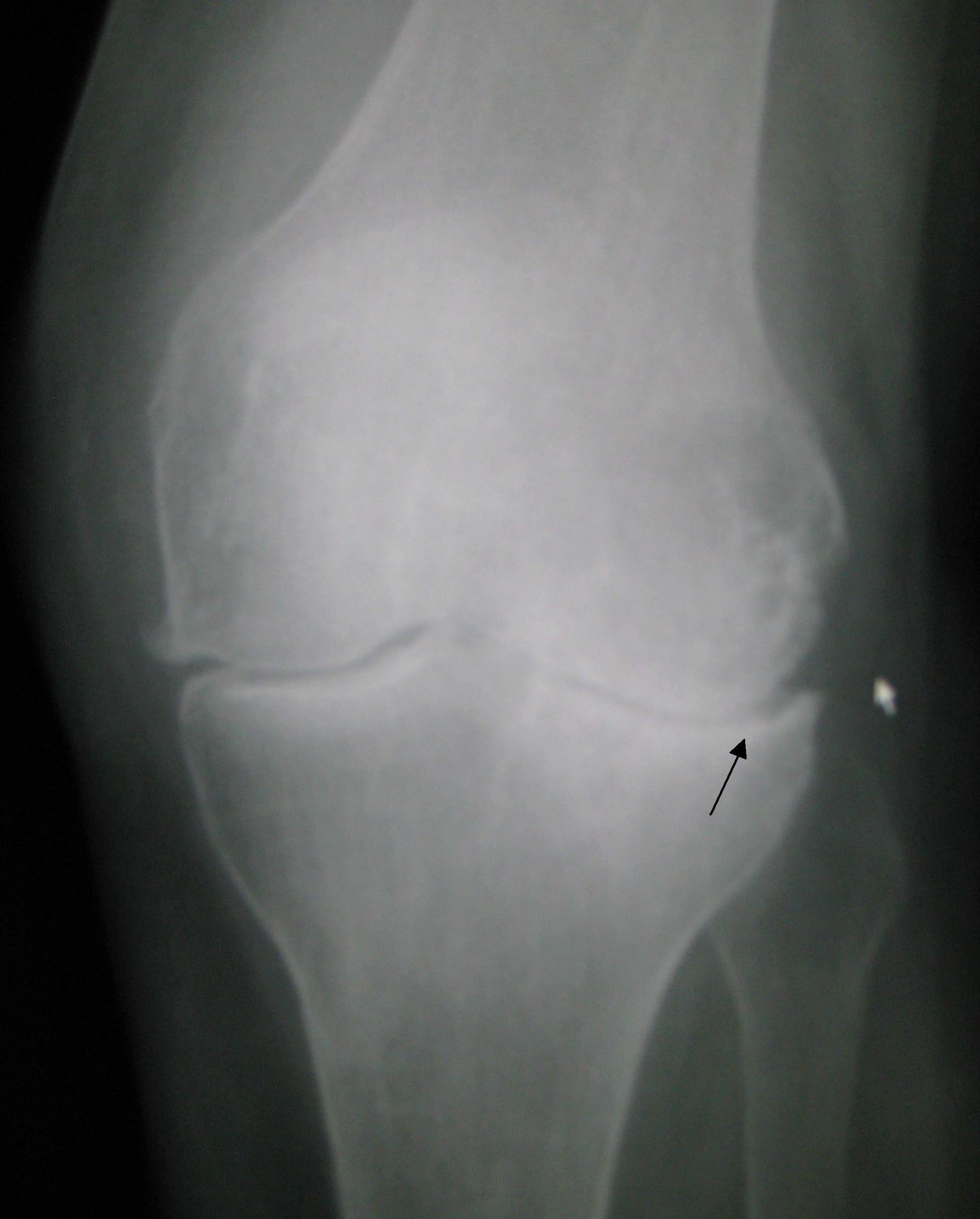 Radiographie de genou gauche de face montrant une arthrose : pincement de l'interligne articulaire signalé par une flèche, ostéophytes et densité osseuse sous-chondrale augmentée.