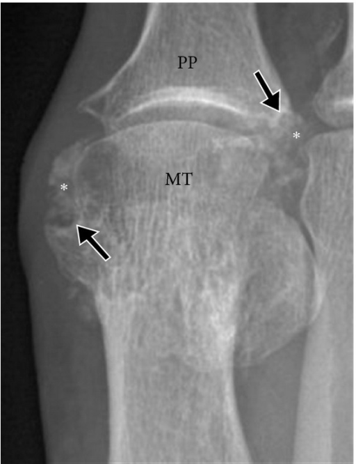 Anteroposterior X-ray of the first metatarsophalangeal joint: calcified soft tissue tophus with adjacent bone erosions, typical signs of tophaceous gout.
