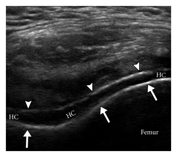 Transverse suprapatellar knee ultrasound: double contour sign, a hyperechoic deposit of uric acid crystals on the surface of the hyaline cartilage, characteristic of gout.