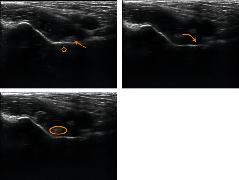 Dynamic hip ultrasound in three stages: the iliopsoas tendon moves away from the bone then snaps abruptly back against it on return to the neutral position, the mechanism of internal snapping hip.