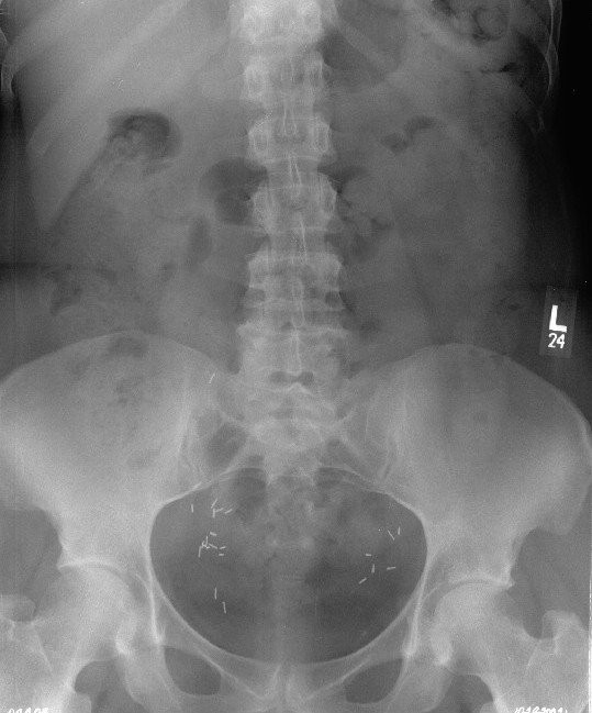 AP lumbar spine radiograph interpreted as normal, illustrating the frequent absence of visible structural abnormality in non-specific low back pain.