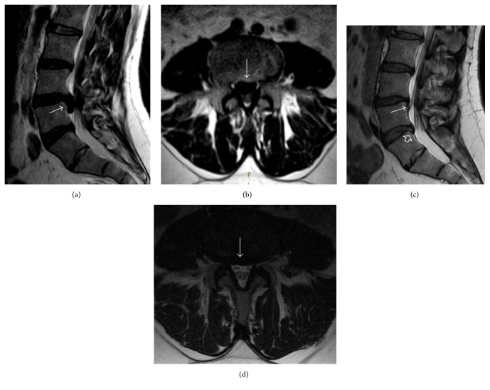 IRM lombaire en coupes sagittale et axiale, pondération T2 : volumineuse hernie discale extrudée et migrée en L4-L5, flèches sur la hernie, puis régression complète de la hernie trois ans plus tard sur les mêmes coupes.
