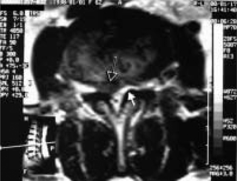 IRM lombaire en coupe axiale : hernie discale latéralisée (flèche noire) associée à une hypertrophie du ligament jaune controlatéral (flèche blanche), à l'origine d'un rétrécissement du canal.