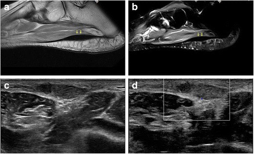 IRM (a, b) et échographie (c, d) du pied : épaississement fusiforme de la partie distale du fascia plantaire, en hyposignal à l'IRM et hypoéchogène à l'échographie, avec hypervascularisation au Doppler, maladie de Ledderhose.
