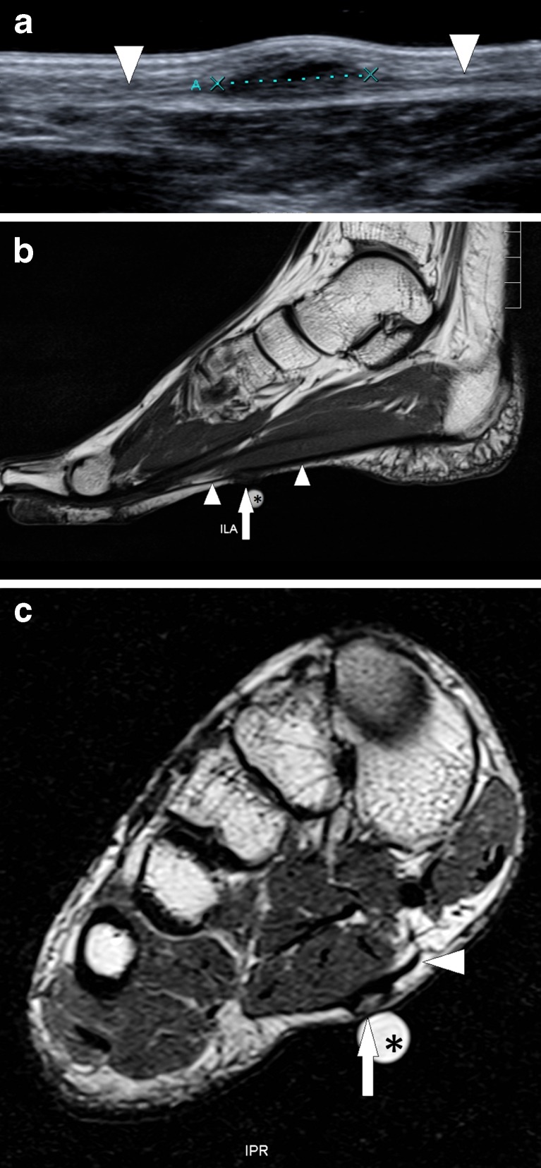 Échographie et IRM du pied : nodule du fascia plantaire délimité par des flèches, fibromatose plantaire.