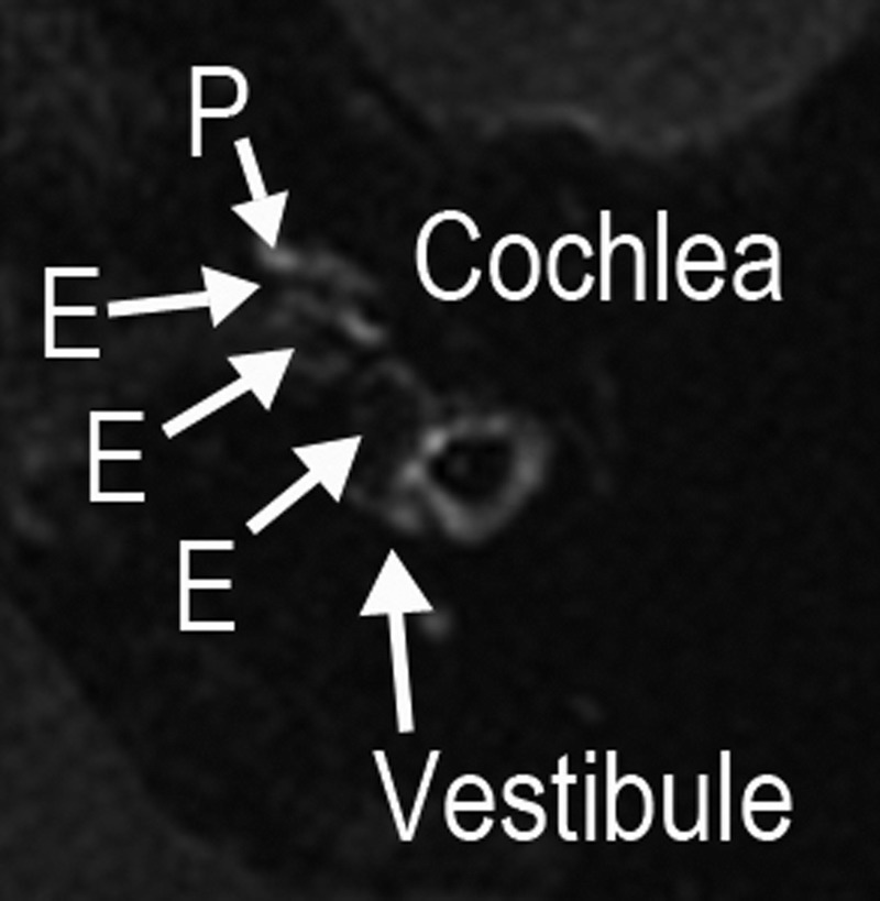 MRI of the inner ear after gadolinium injection: dilation of the endolymphatic space in the cochlea and vestibule, arrows on the distended areas, Menière's disease.