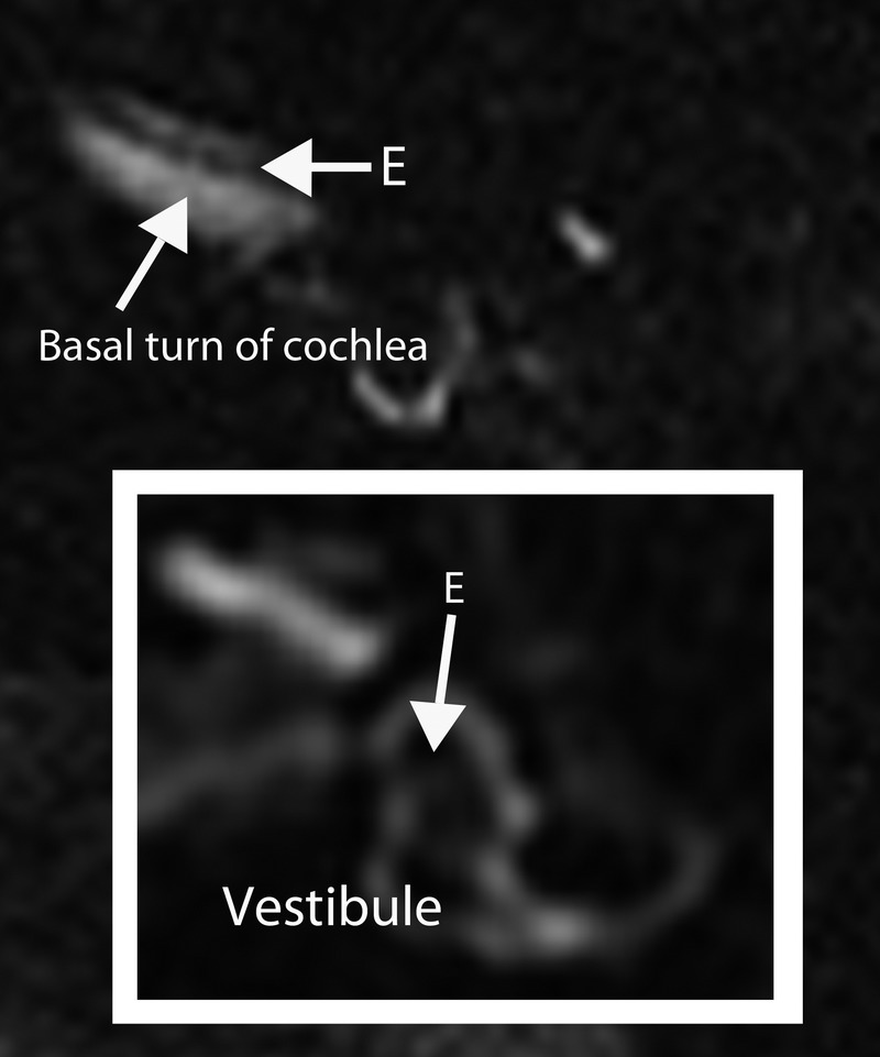 MRI of the inner ear, close-up: isolated dilation of the endolymphatic space in the vestibule without cochlear involvement, arrow on the distended area.
