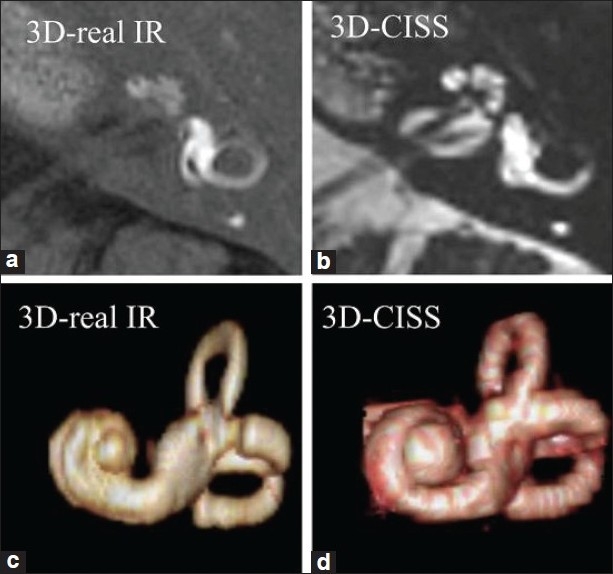 MRI of the labyrinth in a patient with Menière's disease: 3D-real IR and 3D-CISS sequence images (a, b) and their three-dimensional volume-rendered reconstructions (c, d) showing the degree of endolymphatic hydrops.