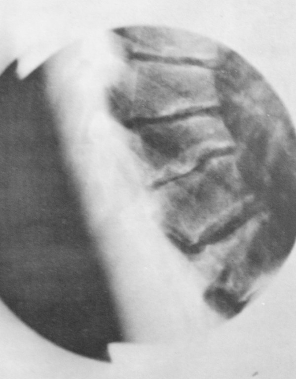 Lateral thoracic spine radiograph showing anterior wedging of several vertebral bodies and endplate irregularity, radiological signs characteristic of late-stage Scheuermann disease.
