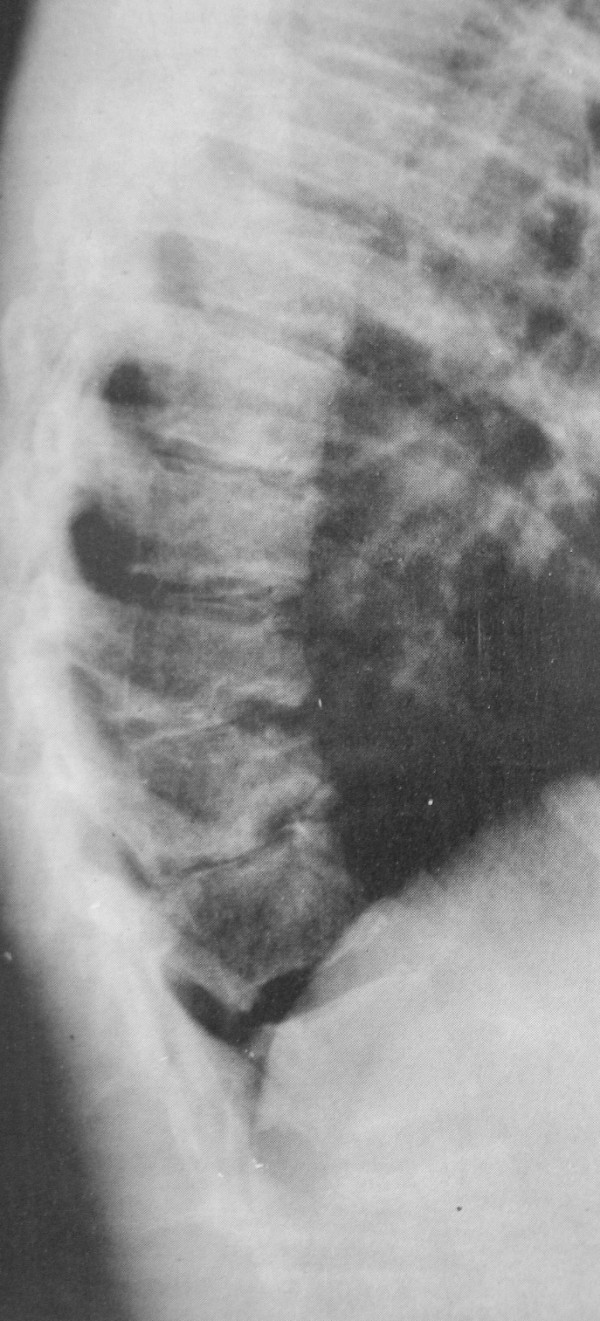 Lateral thoracolumbar spine radiograph showing Schmorl's nodes and marked endplate irregularity, which may be mistaken for infection or tumour if the clinical context is unknown.