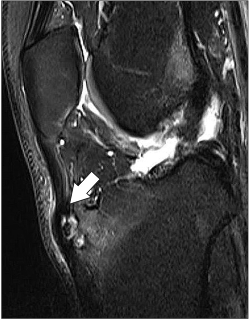 IRM du genou en coupe sagittale pondérée T2 : la flèche indique un épaississement du tendon rotulien et un œdème osseux au niveau de la tubérosité tibiale, avec un fragment non uni en hypersignal, aspect typique de la maladie d'Osgood-Schlatter.