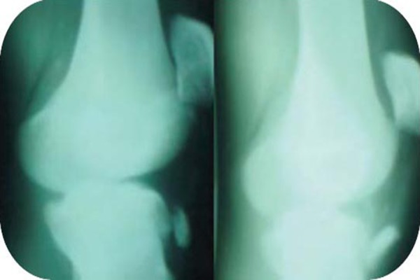 Radiographies des deux genoux montrant une fracture-avulsion bilatérale de la tubérosité tibiale, une complication rare survenant sur une maladie d'Osgood-Schlatter préexistante.