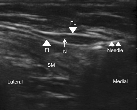 Short-axis ultrasound of the lateral femoral cutaneous nerve between the fascia lata and the fascia iliaca, with the puncture needle in place for an ultrasound-guided block, a technique used in meralgia paraesthetica.